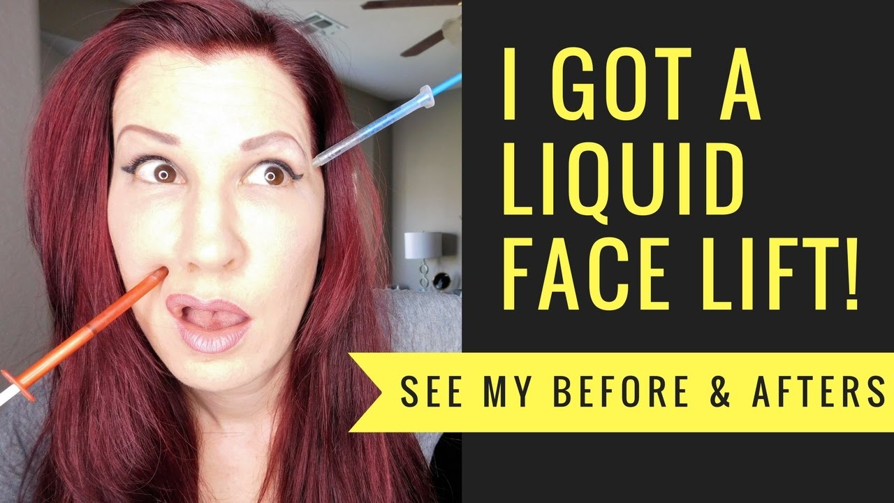 I GOT A LIQUID FACE LIFT! I Botox, Voluma, and Juvederm before and afters. Women over 40!