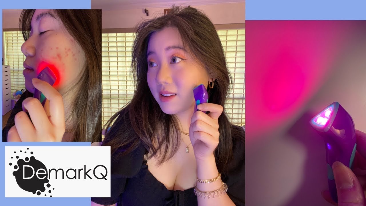 DemarkQ POW Tiny Zit Zapper LED Skin Treatment REVIEW: 1st Impression vs 4 Week Impression