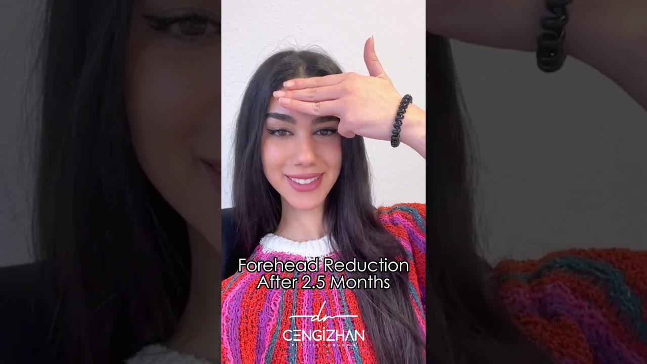 Agudo S.   Forehead Reduction After 2,5 Months