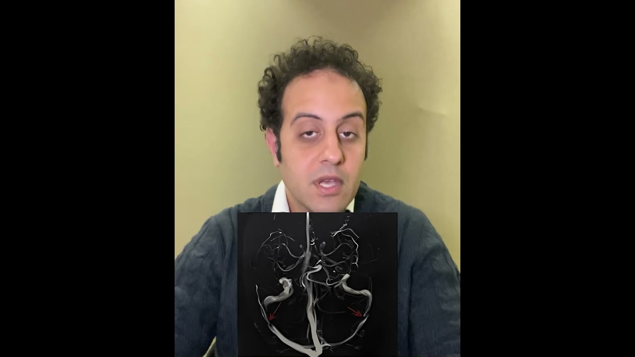 طنين الاذن النابض و تشخيص ضيق و اتساع اوردة المخ المسببه للطنين
