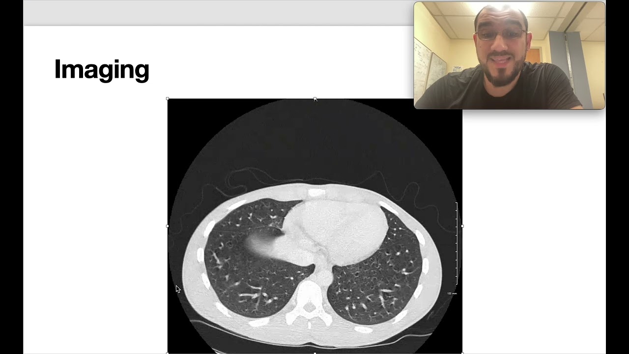 Internal Medicine Quick Cases-2 (Rasmussen aneurysm)