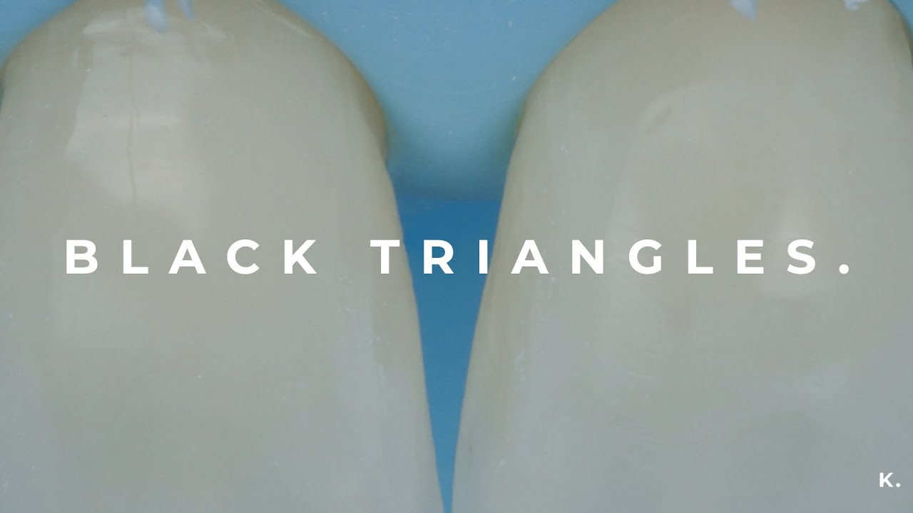 How to close black triangles
