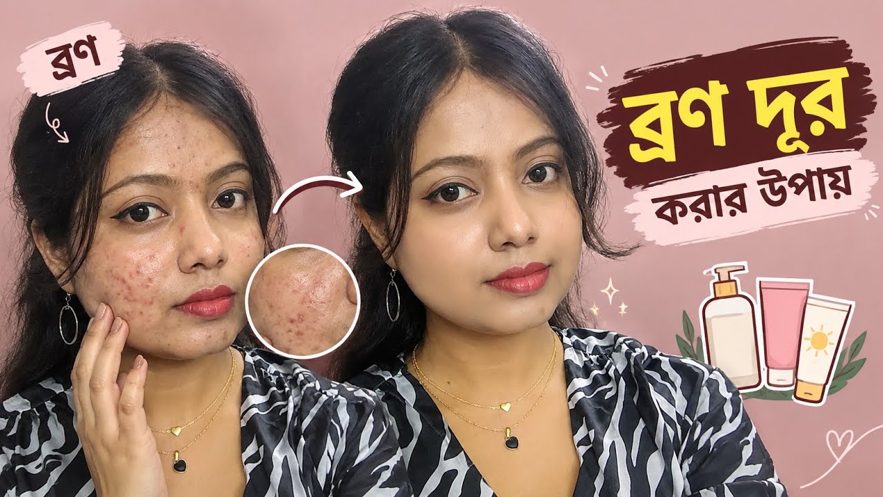 ব্রণ দূর করার উপায় 🔥| Stop Acne🛑 #acneremoval #acne #facewash 