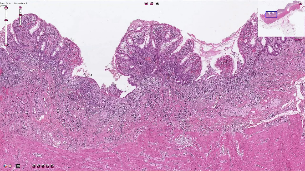 Ulcerative Colitis - Histopathology