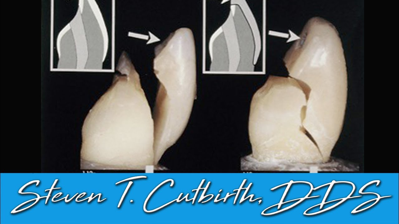 How to Make Your Veneers as Strong as Teeth - Dental Minute with Dr. Steven T. Cutbirth, DDS