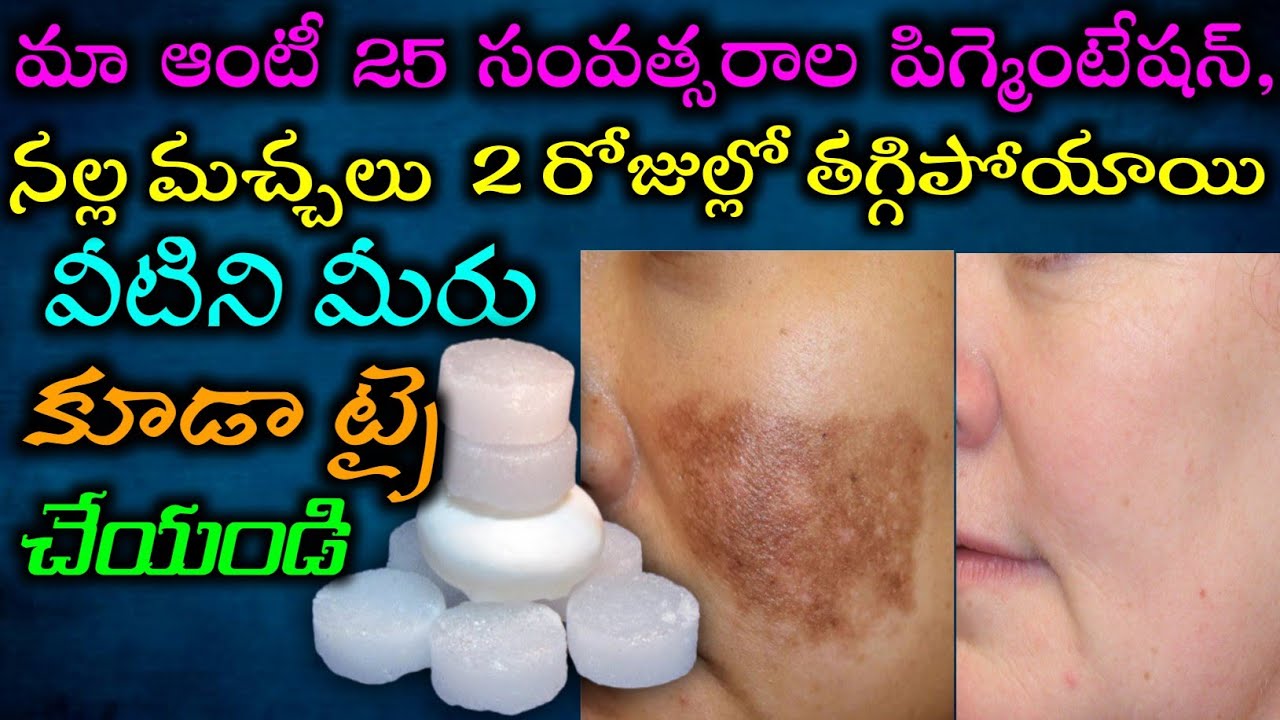 🔥ఒక్కసారి ఇలా చేస్తే కనుక పిగ్మెంటేషన్ , నల్లమచ్చలు అన్ని పోయి 2 రోజుల్లో స్కిన్ గ్లో ఉంటుంది| 💯work