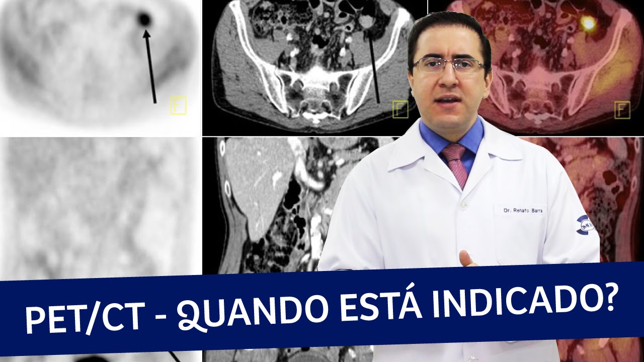 PET Scan ou PET/CT | Quando está indicado o exame | IMEB