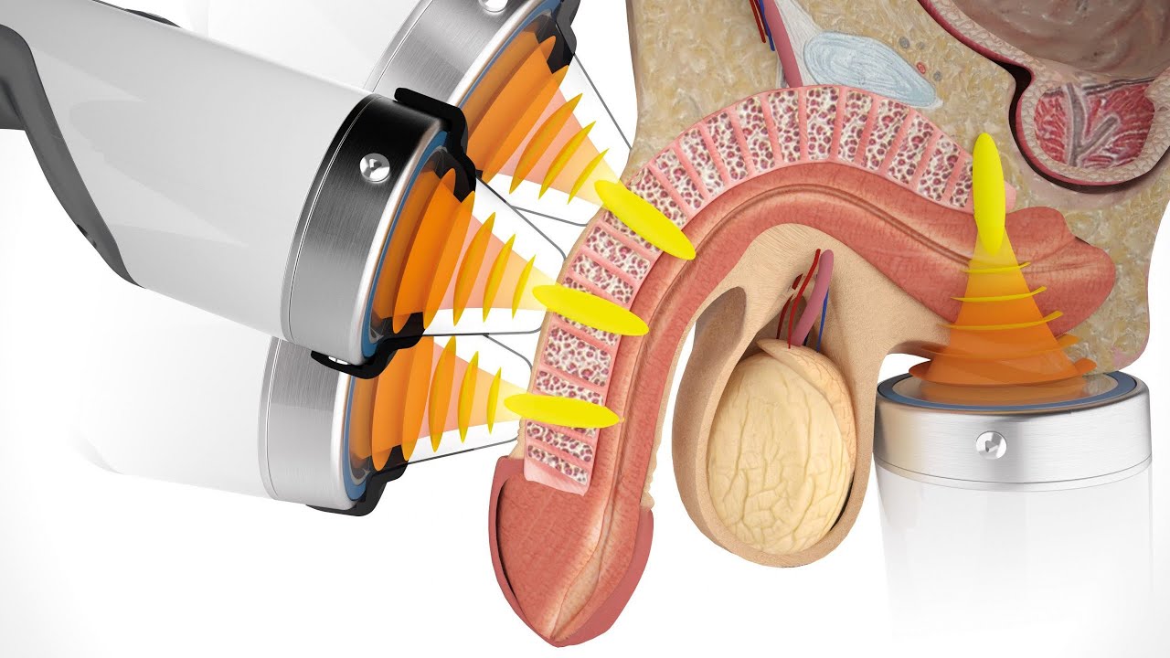 Shockwave Therapy For Erectile Dysfunction