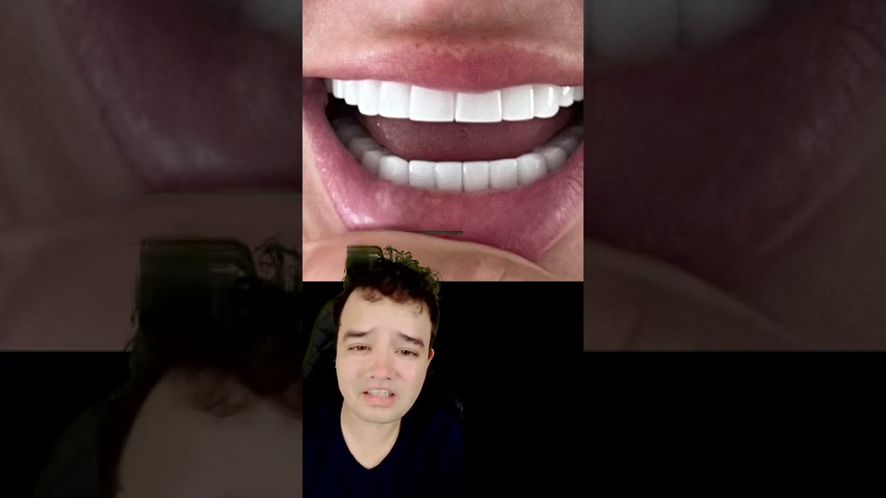 As facetas de porcelana dela deram MUITO ERRADO #shorts