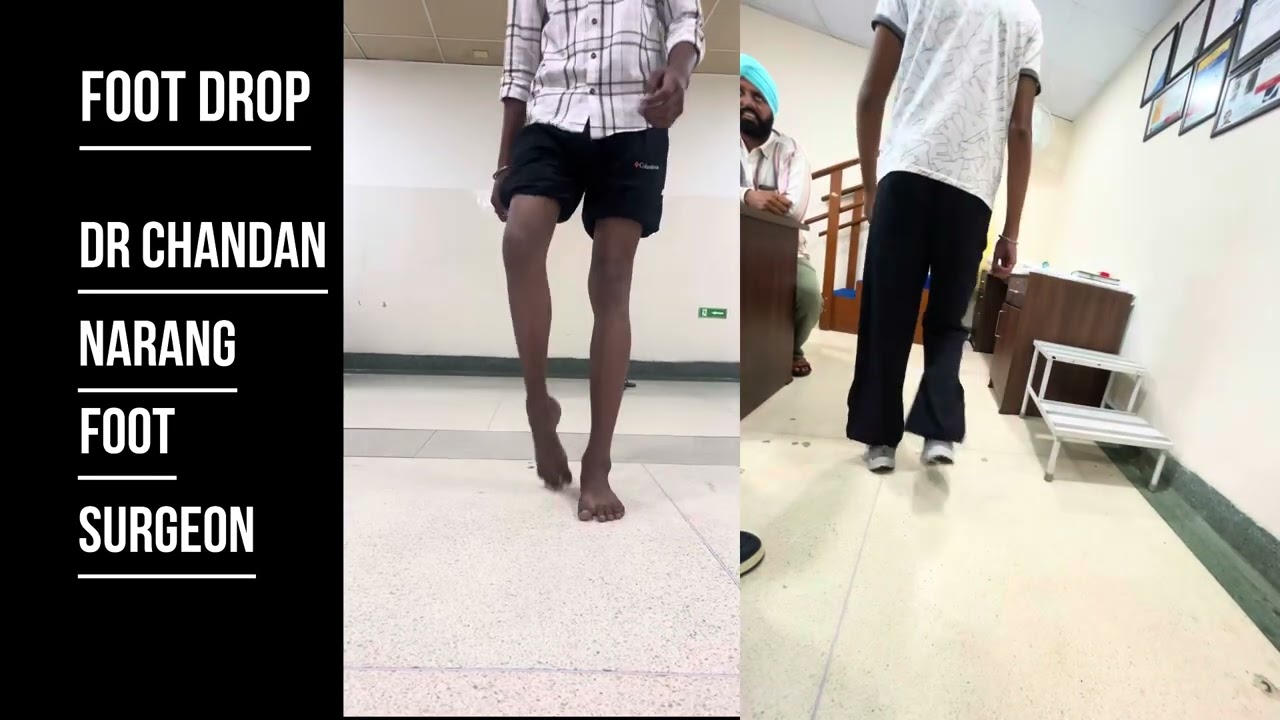 Foot drop Recovery / Success after Foot drop surgery / Tendon transfer  / Dr Chandan Narang / foot