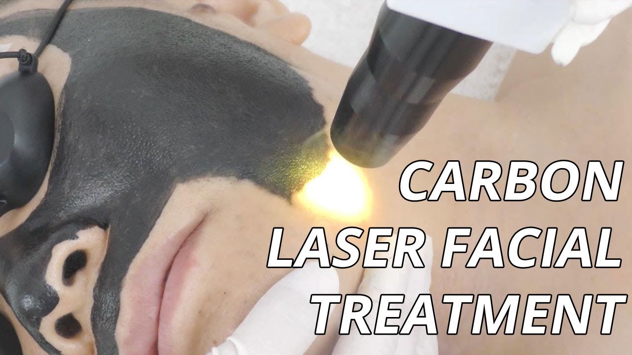 Can This Carbon Laser Facial Treat Melasma? Carbon Laser Peel (How It Works)