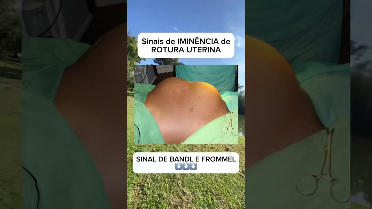 Imin&ecirc;ncia de rotura uterina!