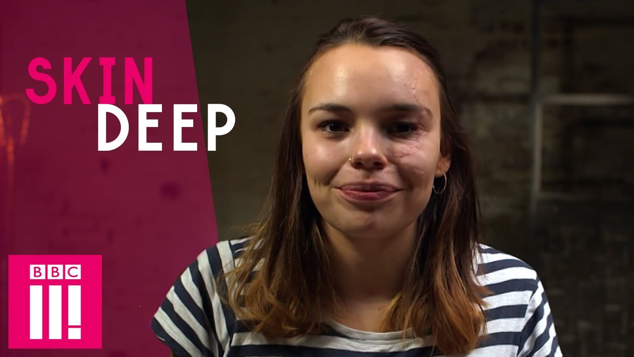 Being Confident With Facial Scarring | Phyllida | Skin Deep