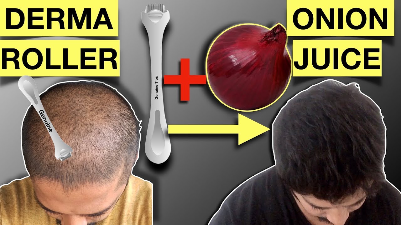 Onion Juice and Derma Roller for Hair Growth. प्याज का रास और डर्मा रोलर का उपयोग कैसे करें?