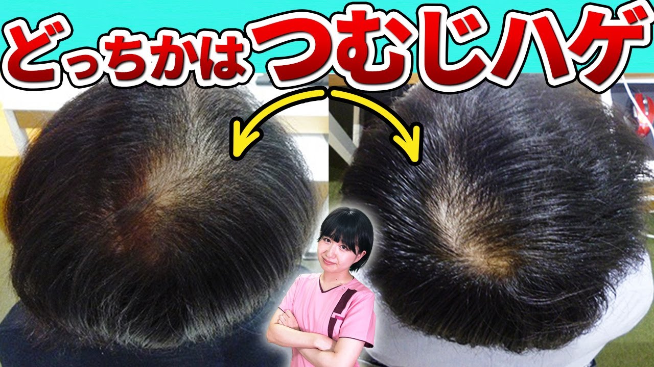 【すぐ確認】つむじハゲの確認方法と対策