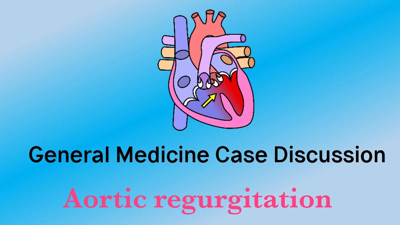 General medicine case discussion || Aortic Regurgitation