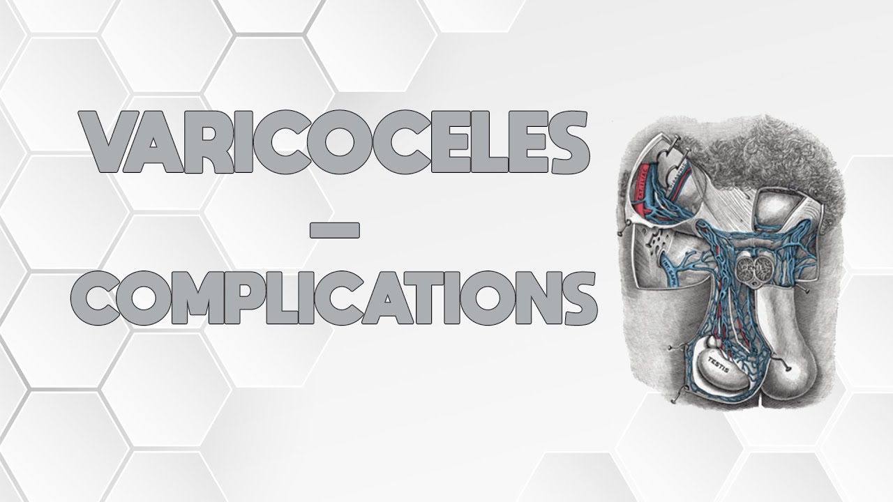 LES VARICOCÈLES - COMPLICATIONS