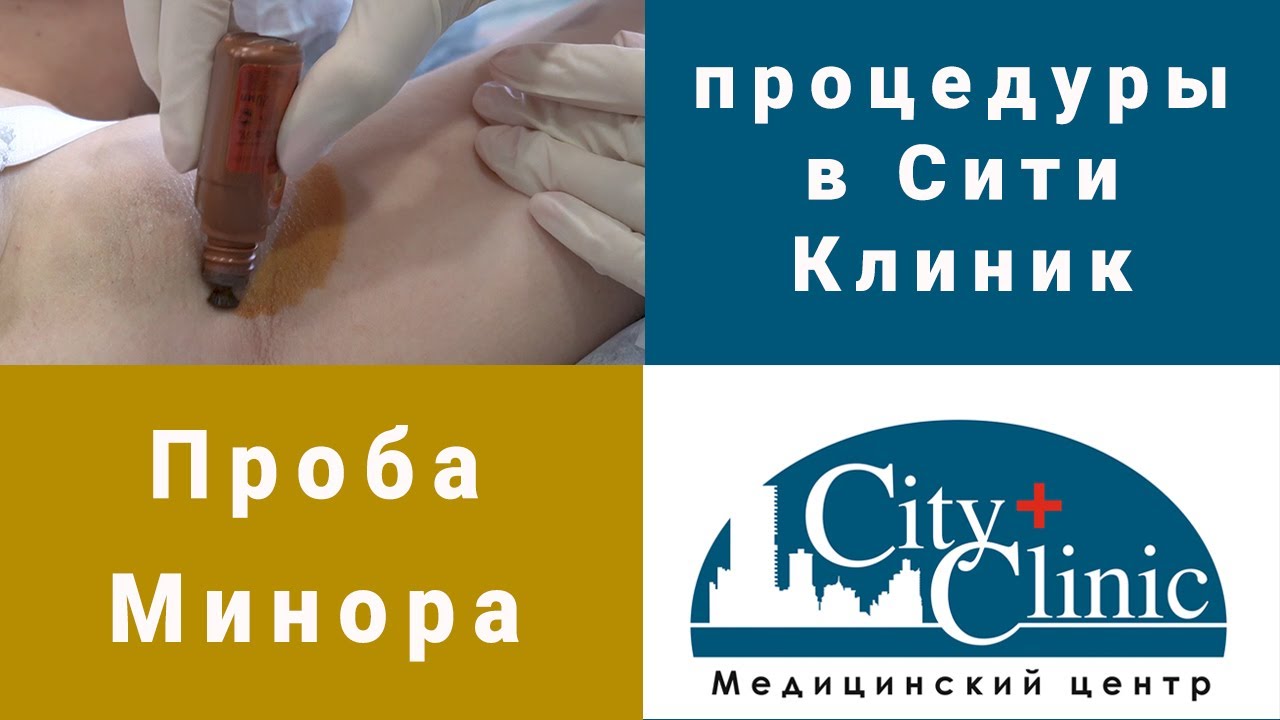 Проба Минора для диагностики Гипергидроза