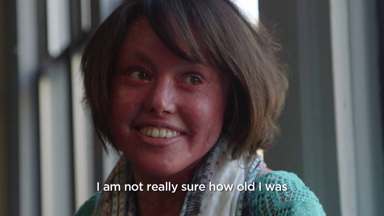 What is Ichthyosis?