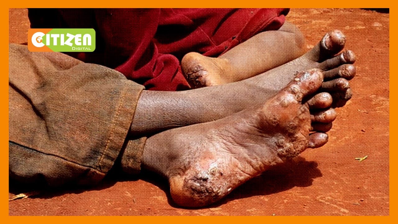 Wanakijiji wa Ibencho, Kenyenya waokoa familia Kisii iliyovamiwa na funza