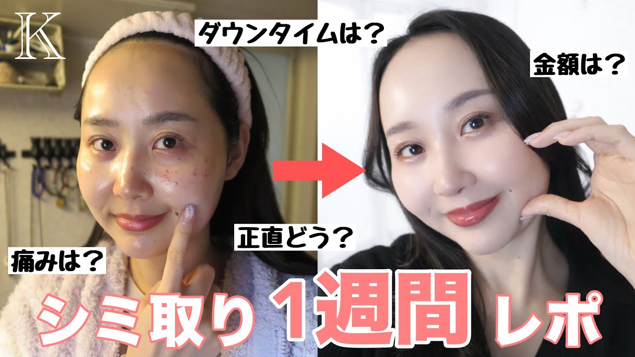 【リアル経過】シミ取り1週間レポ