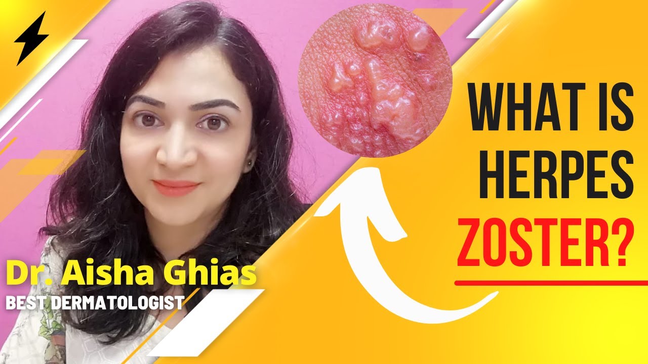What is Herpes Zoster? Herpes Zoster Causes, Symptoms and Infection in Hindi/Urdu | Kalwatra Ka Ilaj