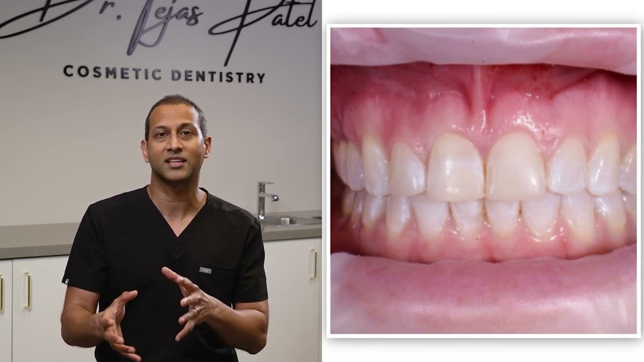 Veneer Course Preview:  Case selection for porcelain veneers