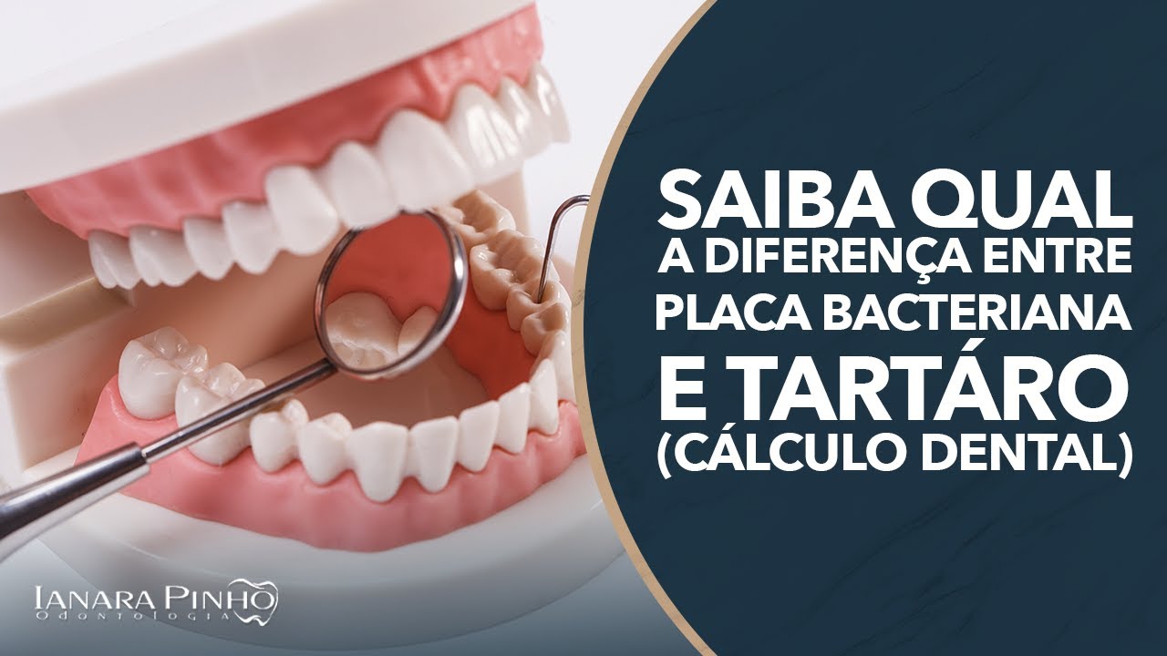 Saiba Qual a Diferen&ccedil;a entre Placa Bacteriana e T&aacute;rtaro (C&aacute;lculo Dental) | Ianara Pinho