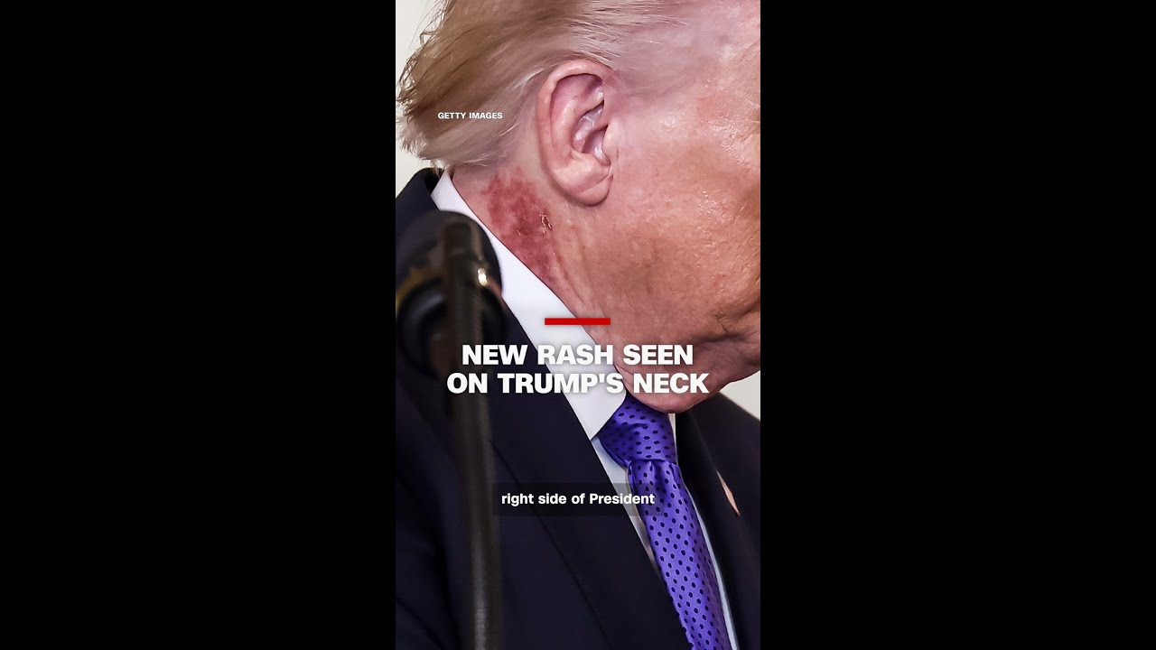 New rash seen on Trump's neck