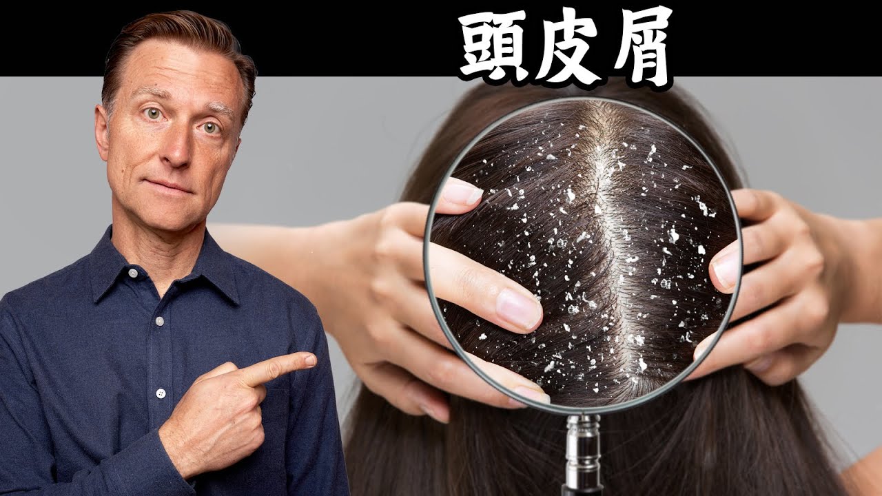 消除頭皮屑,益生菌自然療法,柏格醫生 Dr Berg