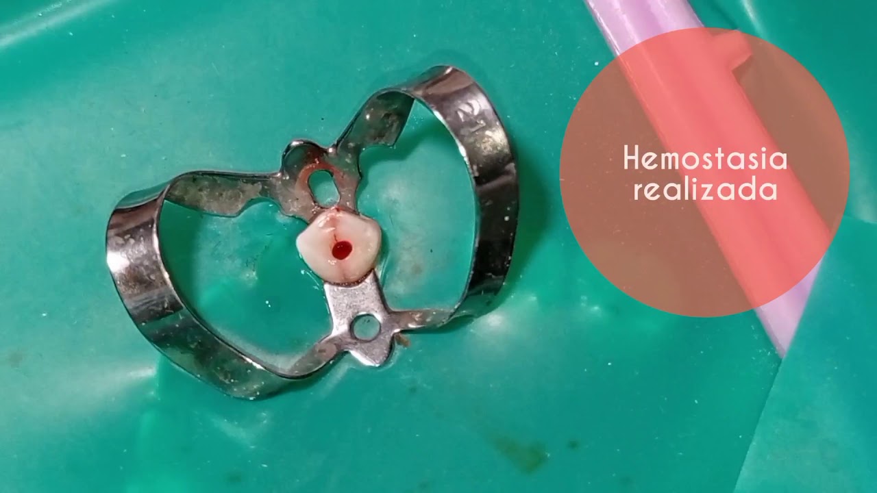 PULPOTOMIA EN DIENTES TEMPORALES