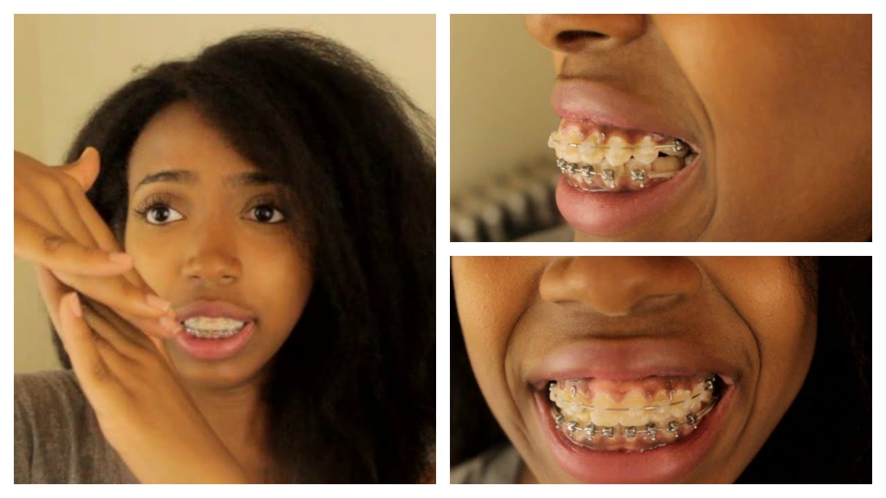 Adult Braces Journey Part 6 Update: Powerchains, Pain, Overbite improvement and smaller teeth