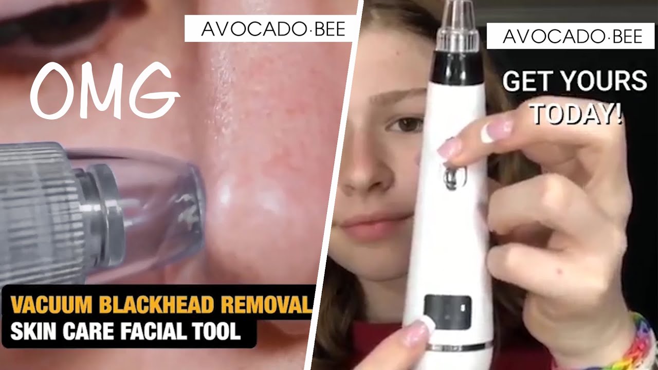Blackhead Remover Vacuum Pore Cleaner | Does It Work?