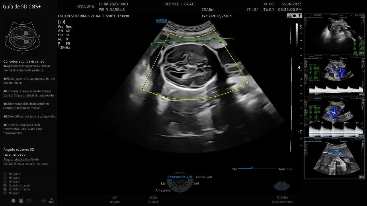 OBSTET 2. Con el Hera w10 Elite.