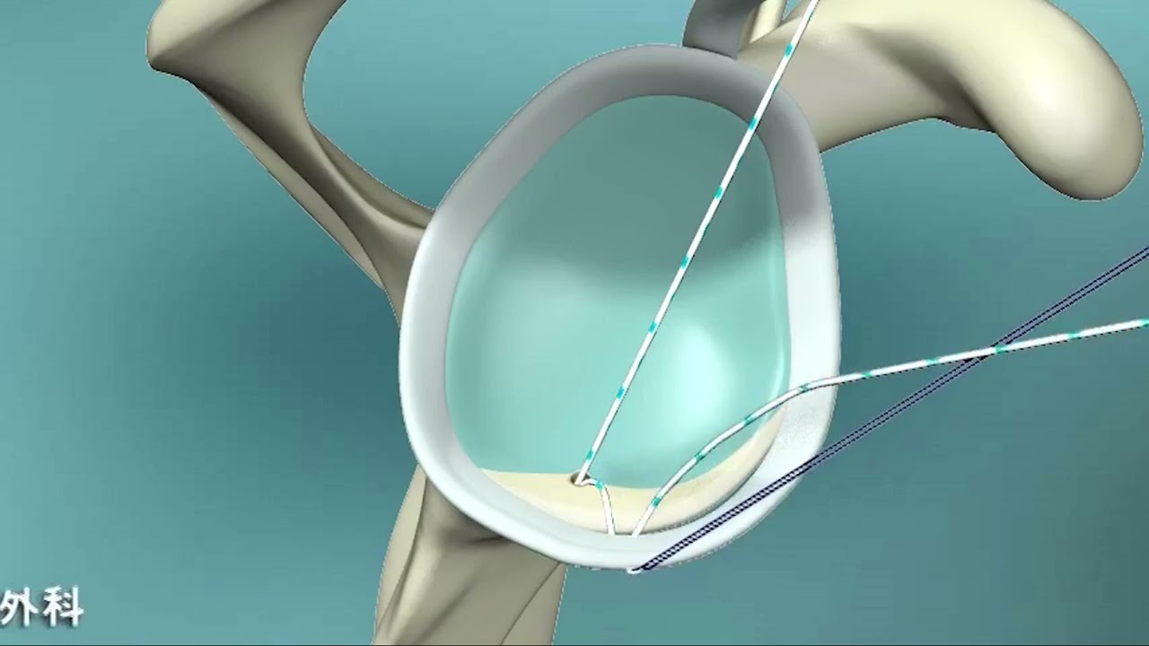 Arthroscopic Bankart Repair surgical procedure (3D animation) -Hachioji Sports Clinic-