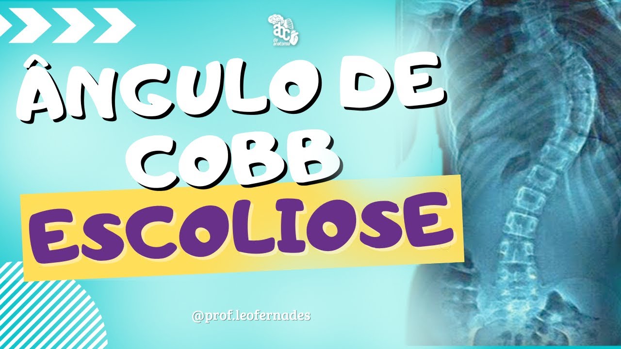 COMO MEDIR O ÂNGULO DE COBB ? #escoliose #cobb