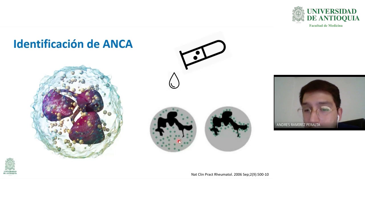 Vasculitis ANCAs Positivo - Dr. Andrés Ramírez
