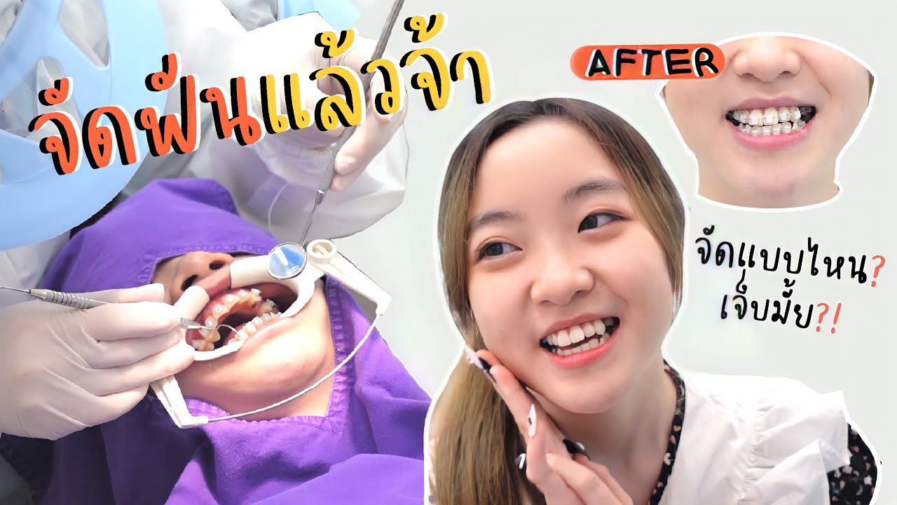 อุ้มจัดฟันแล้ววว!! | จัดแบบไหน จัดที่ไหน เจ็บมั้ย?! บอกทุกรายละเอียด | OUMTTP