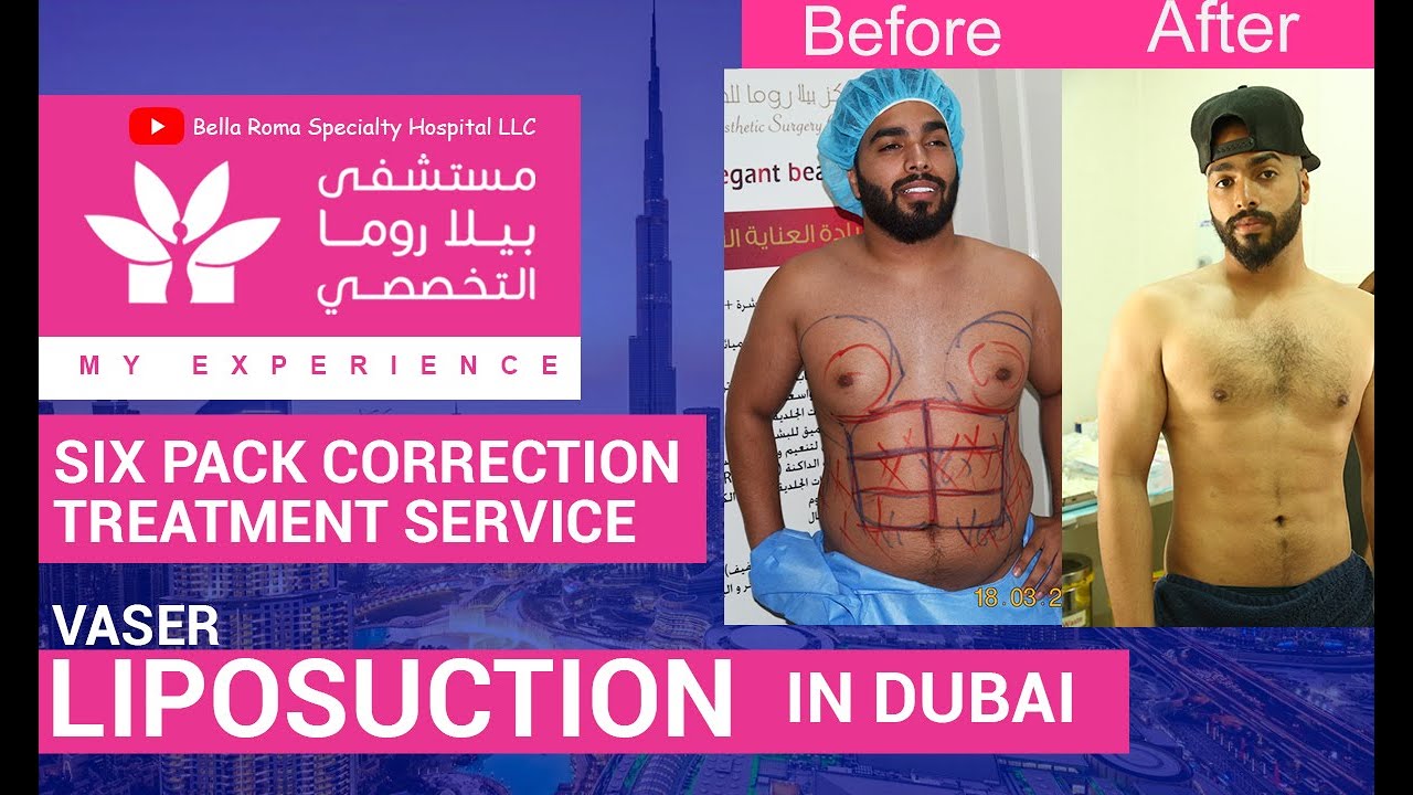 Vaser Liposuction for 6 Pack Abs in Bella Roma Dubai  | افضل علاج لشفط الدهون بجهاز الفايزر