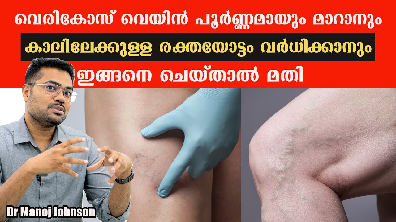 വെരികോസ് വെയിൻ പൂർണ്ണമായും മാറാനും കാലിലേക്കുള്ള രക്തയോട്ടം വർധിക്കാനും /Dr Manoj Johnson