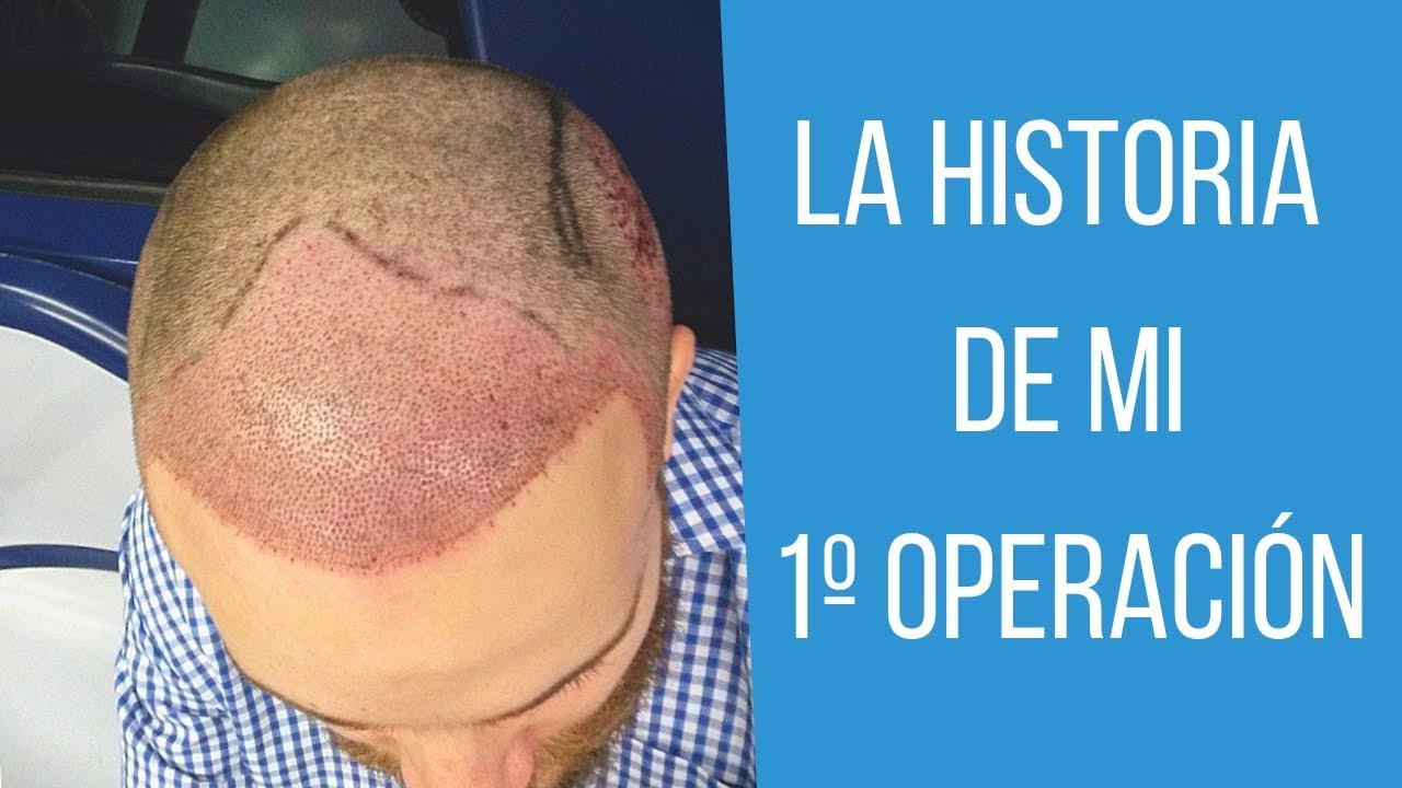 Hablemos de mi 1º operación de trasplante de pelo en España