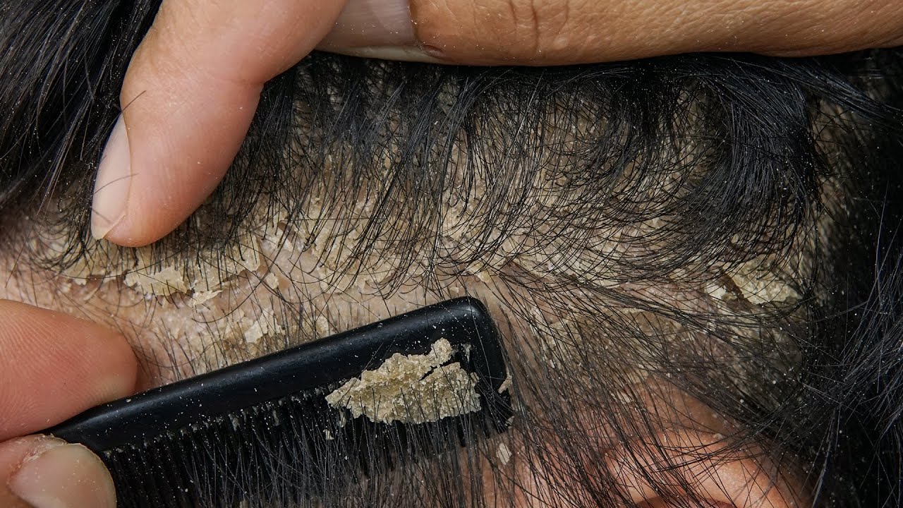 Satisfying Scalp Dandruff Removal: Comb Scratching Big Flakes #DMO3748