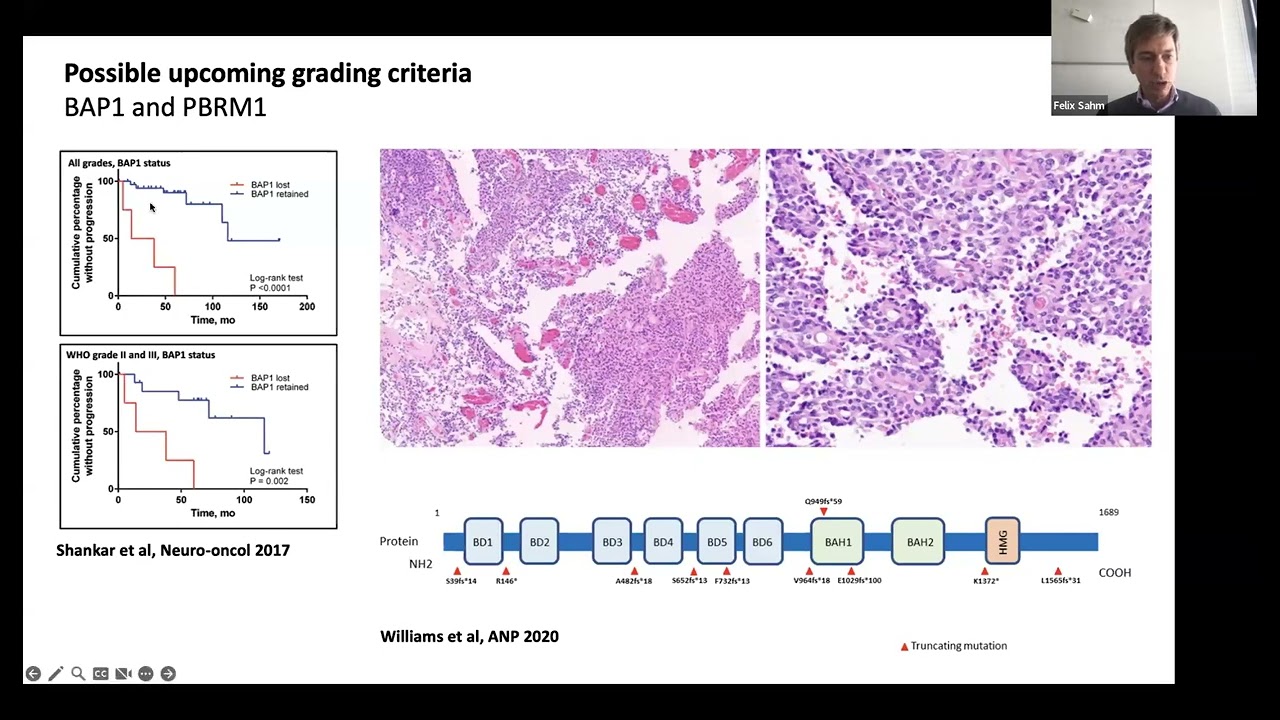 EANS WEBINAR: MENINGIOMAS