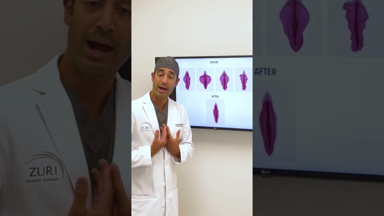 Лабиопластика у доктора Зури в Майами | Zuri Plastic Surgery