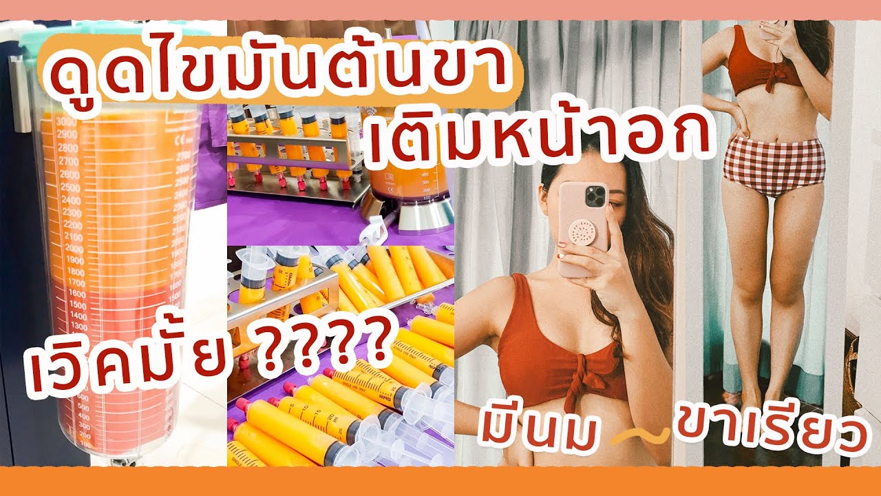 รีวิวดูดไขมันต้นขา เติมไขมันหน้าอก ปังหรือพัง ? | dreamnachon