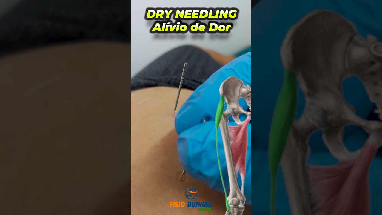 Dry needling para Dor - Fisioterapia
