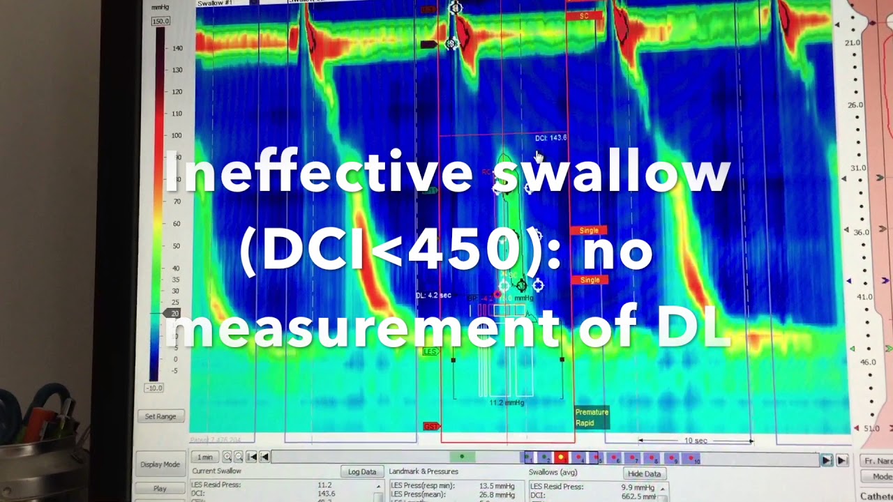 Analysis of Esophageal High Resolution Manometry ESNM Teaching Video