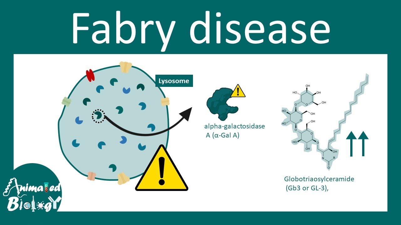 Fabry disease | Lysosomal storage disorder