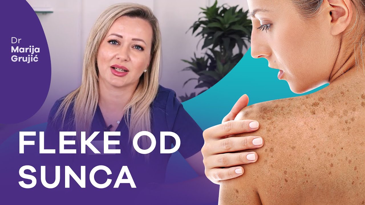 Sunčane fleke i pegice na licu, vratu, rukama - kako ih sprečiti i da li se mogu skinuti?