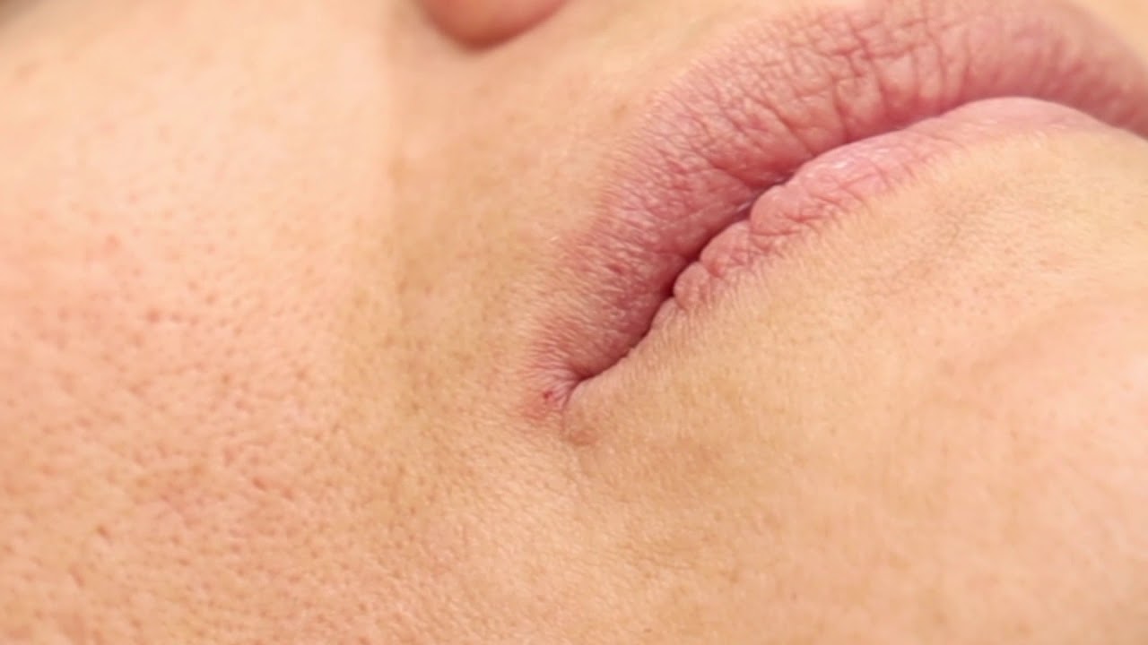 Rejuvenecimiento labial con LIPS SOFT